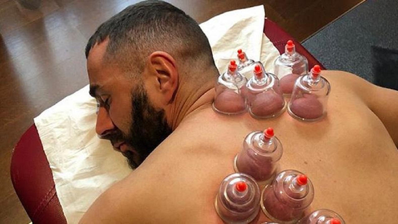 Bekam Steril / Cupping